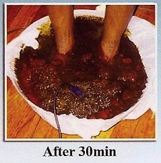 Image of foot detox after 30 minutes foot detox after 30 minutes